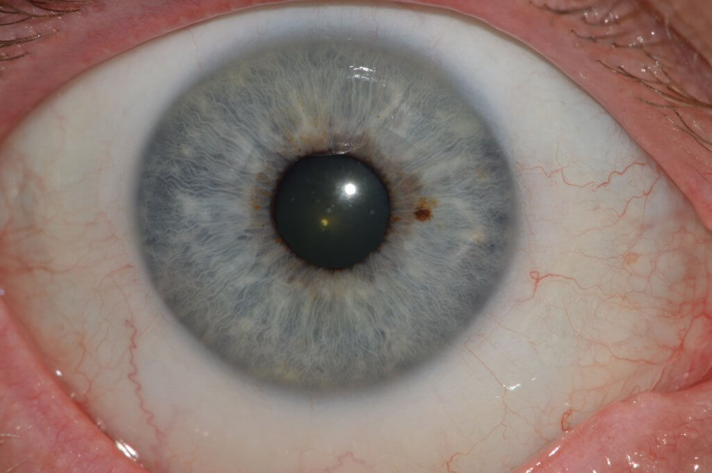 eye health
